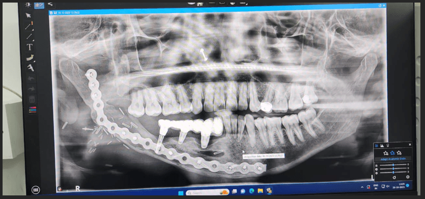 Corticobasal ® Implants: Immediate Loading Following Mandibulectomy