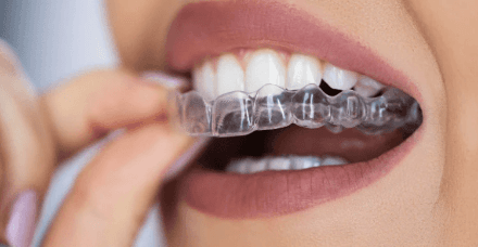 Aligners