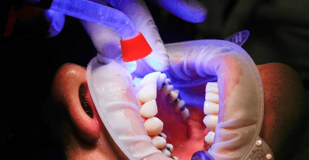 Composite Restorations