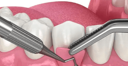 Flap Surgery