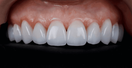Frenectomy