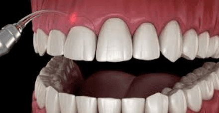 Gingivectomy