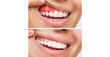 Gum Depigmentation