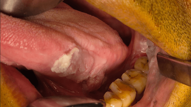 Figure 1. Case 1 – Preoperative clinical view showing the ulcerative lesion on the left lateral border of the tongue.