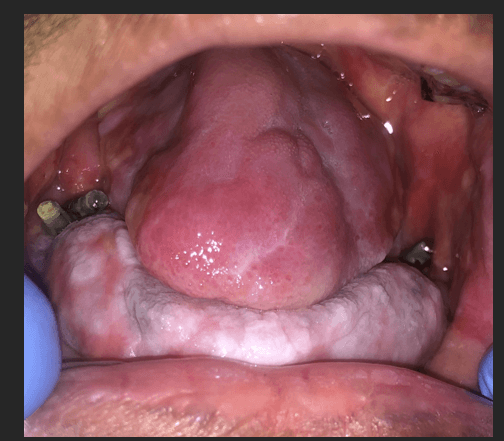 Figure 10. Case 2 – Intraoperative photograph post radiation and flap mucosalised, the provisional denture was not retentive.