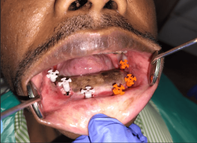 Figure 11. Case 2 – 6 BCS corticobasal implants ® placed with impression caps
