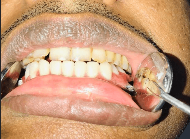 Figure 12. Case 2 – Metal framework was tried in