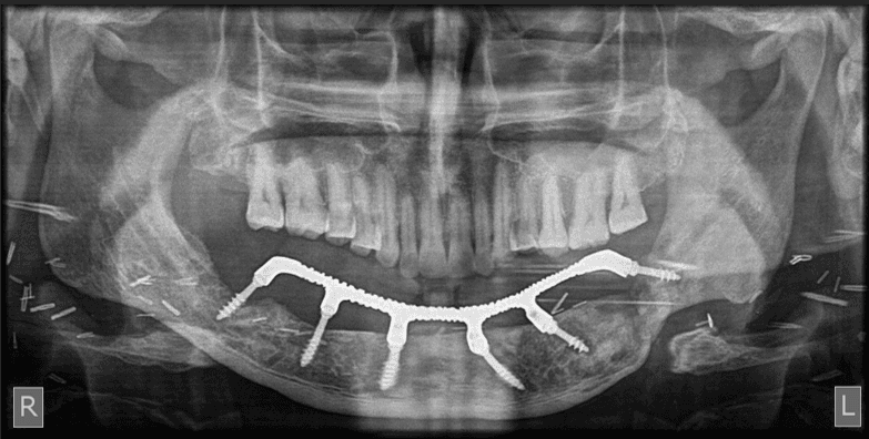Figure 13. Case 2 – Teeth try in