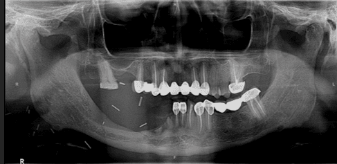 Figure 14. Case 2 – Clinical photograph at follow-up demonstrating satisfactory soft tissue health around implant collars.