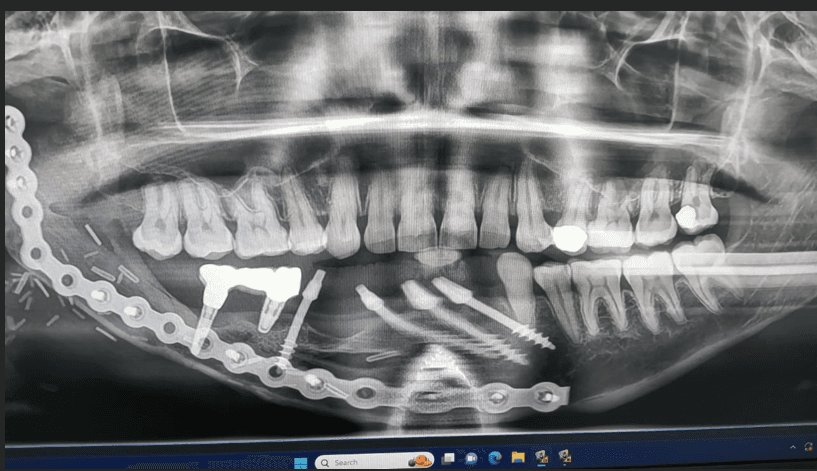 Figure 17. Case 3 – Intraoral view following placement of six BCS implants with FAMM flap coverage.