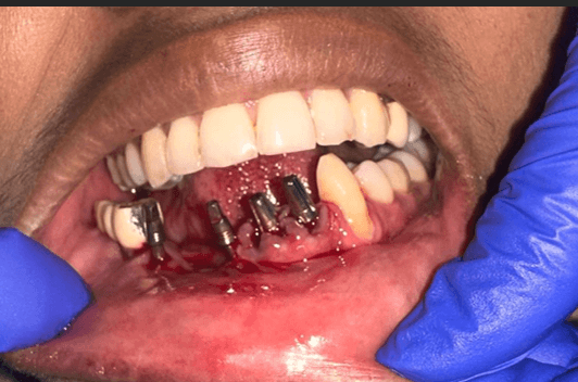 Figure 18. Case 3 – BCS implants with G-Cam prosthesis