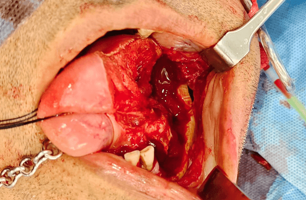 Figure 2. Case 1 – Preoperative PET-CT axial slice demonstrating the localised lesion without regional nodal uptake.