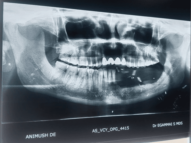 Figure 3. Case 1 – Intraoperative view following left glossectomy and marginal mandibulectomy with FRAFF reconstruction.