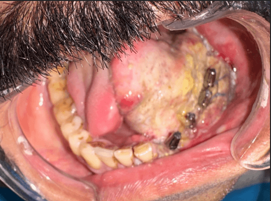 Figure 4. Case 1 – Intraoral view of implant abutments following debulking and sulcoplasty.