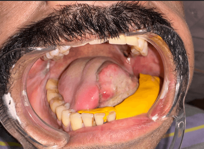 Figure 5. Case 1 – Postoperative panoramic radiograph demonstrating placement of four BCS implants engaging the inferior mandibular cortex.