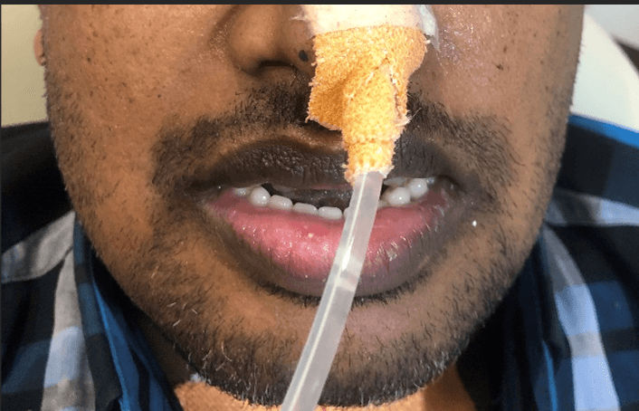 Figure 8. Case 2 – Provisional prosthesis in situ immediately post-surgery, maintaining lower lip support during radiotherapy.
