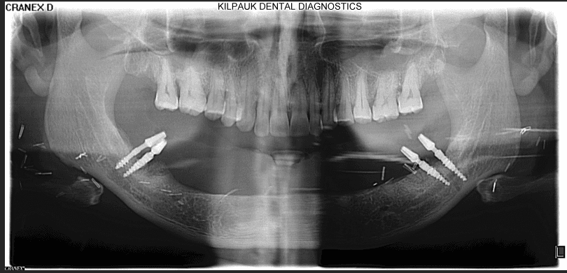 Figure 9. Case 2 – Panoramic radiograph taken at time of primary implant placement (four BCS implants in native bone).