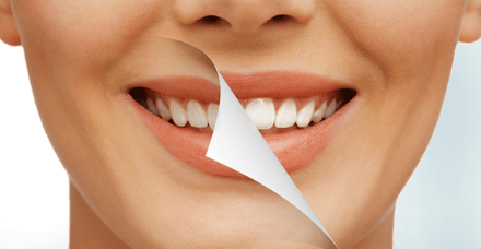 Dental Bleaching