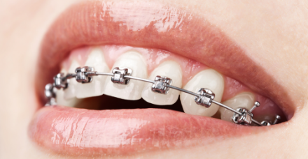 Fixed Orthodontics