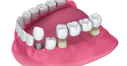 Replace Missing Teeth