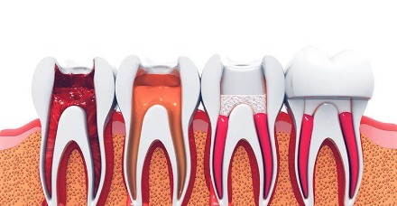Root Canal Procedure